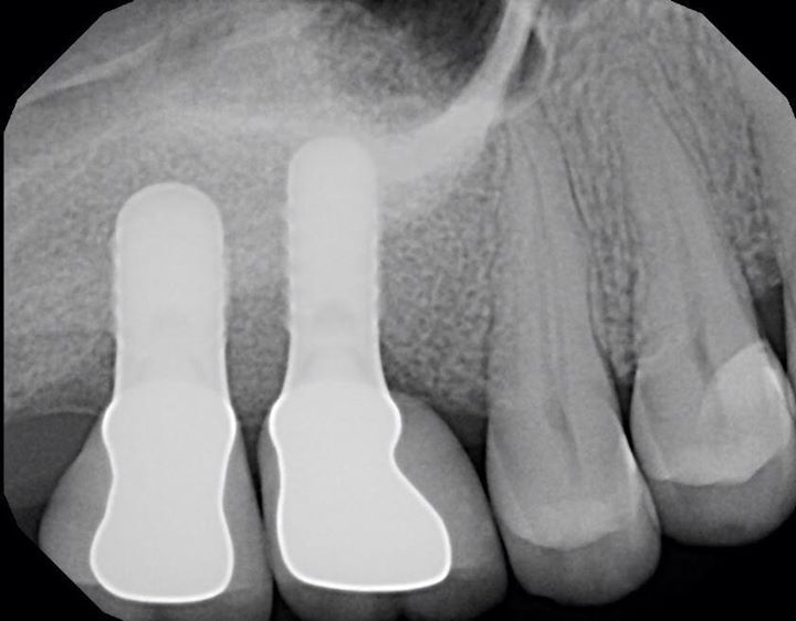 Clinical Cases - Methuen Periodontics And Implant Dentistry